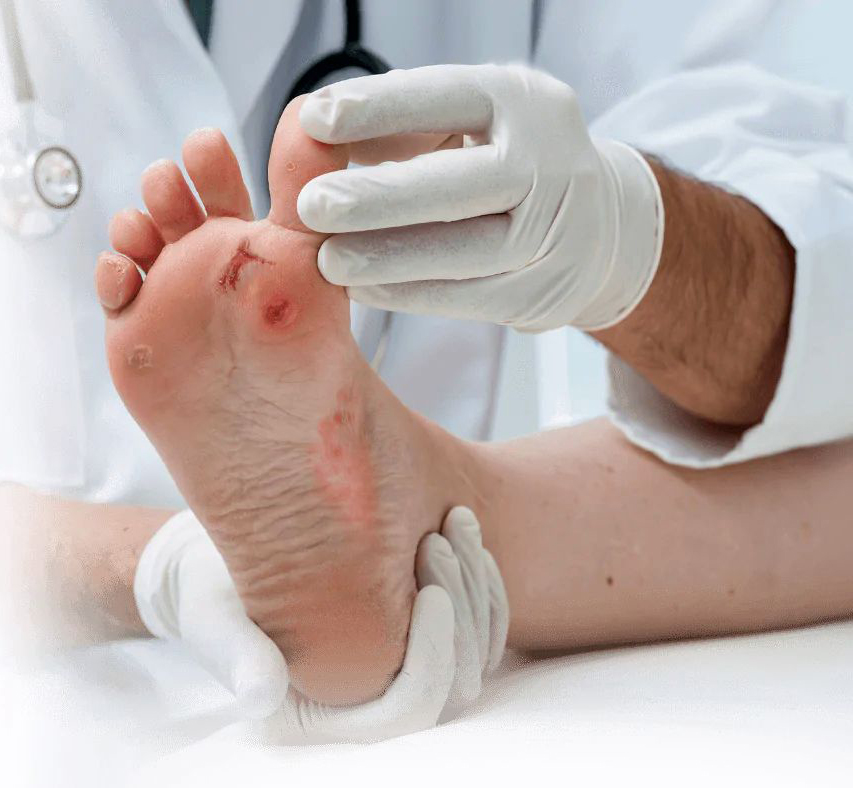 Діабетична стопа