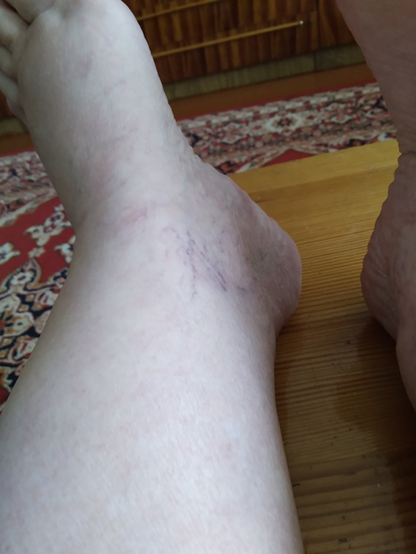 Варикоз фото