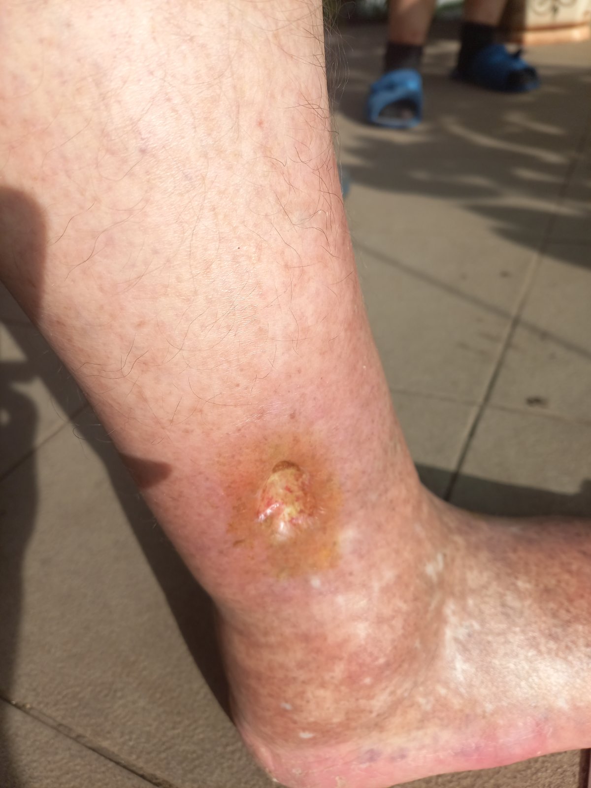 Трофічна рана